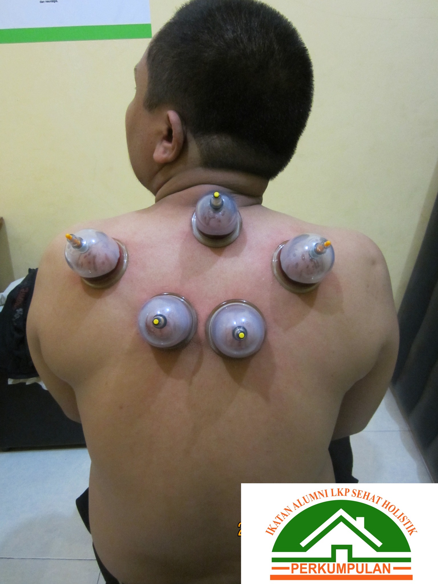 Batuk Kering dan Terapi Bekam