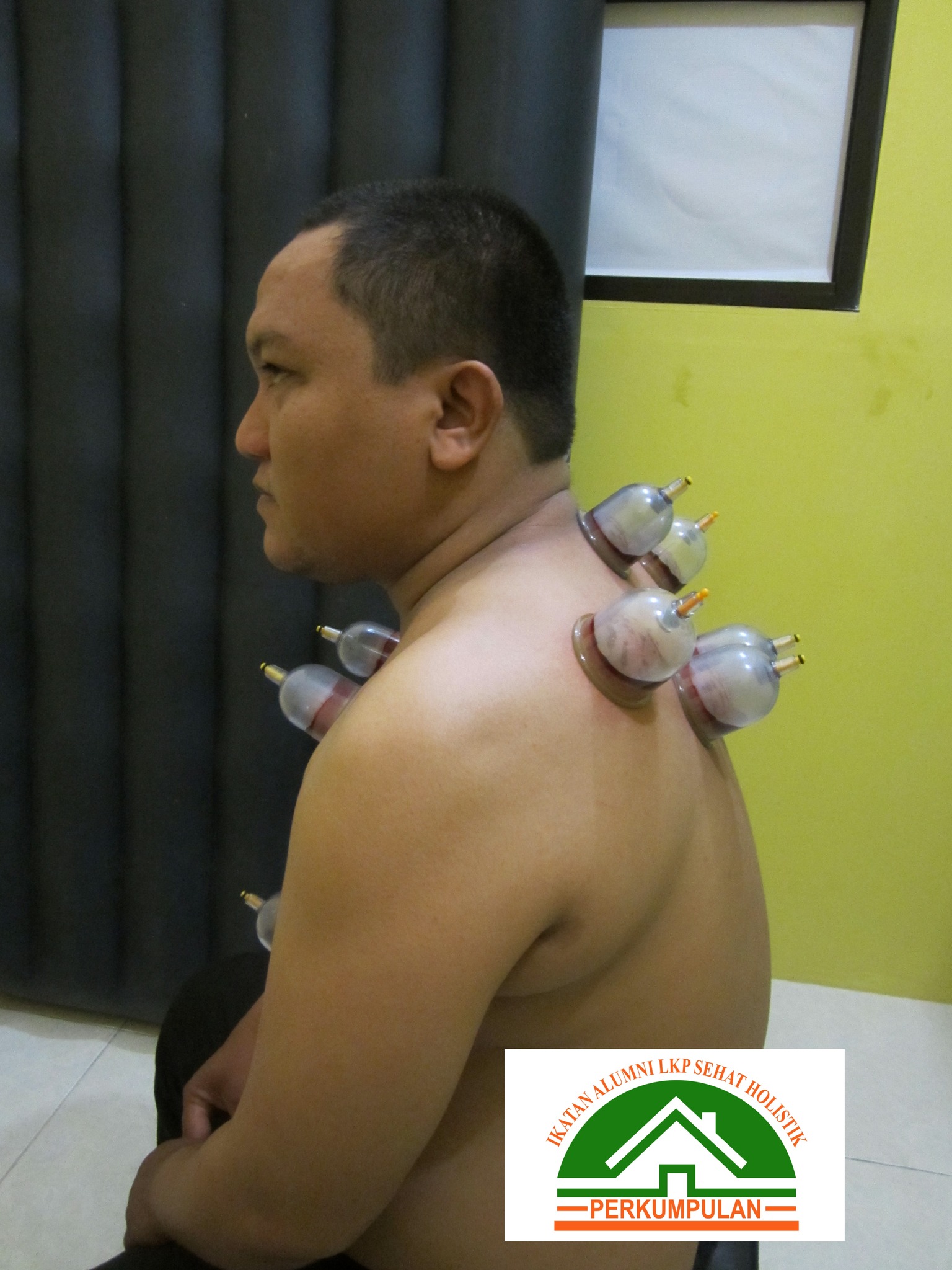 Terapi Bekam Efektif Atasi Gumpalan Darah